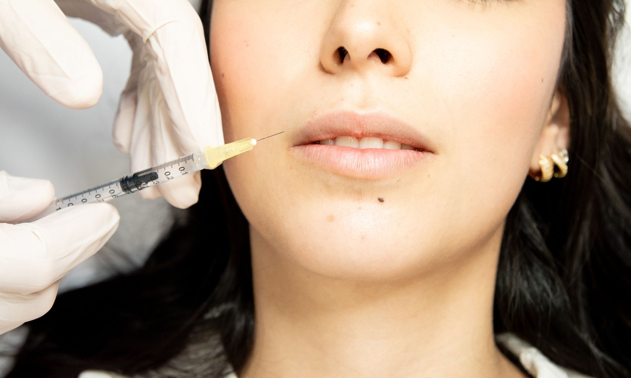 Filler acido ialuronico - Pietro Serra Chirurgo Plastico