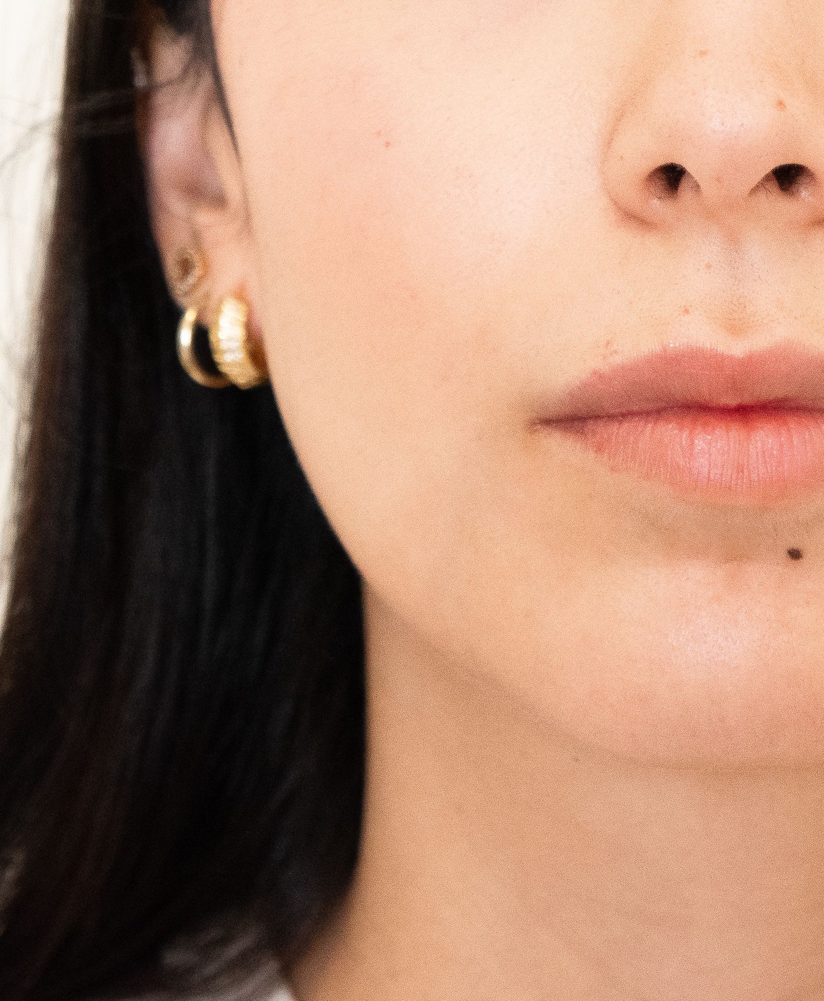 mentoplastica - Pietro Serra Chirurgo Plastico