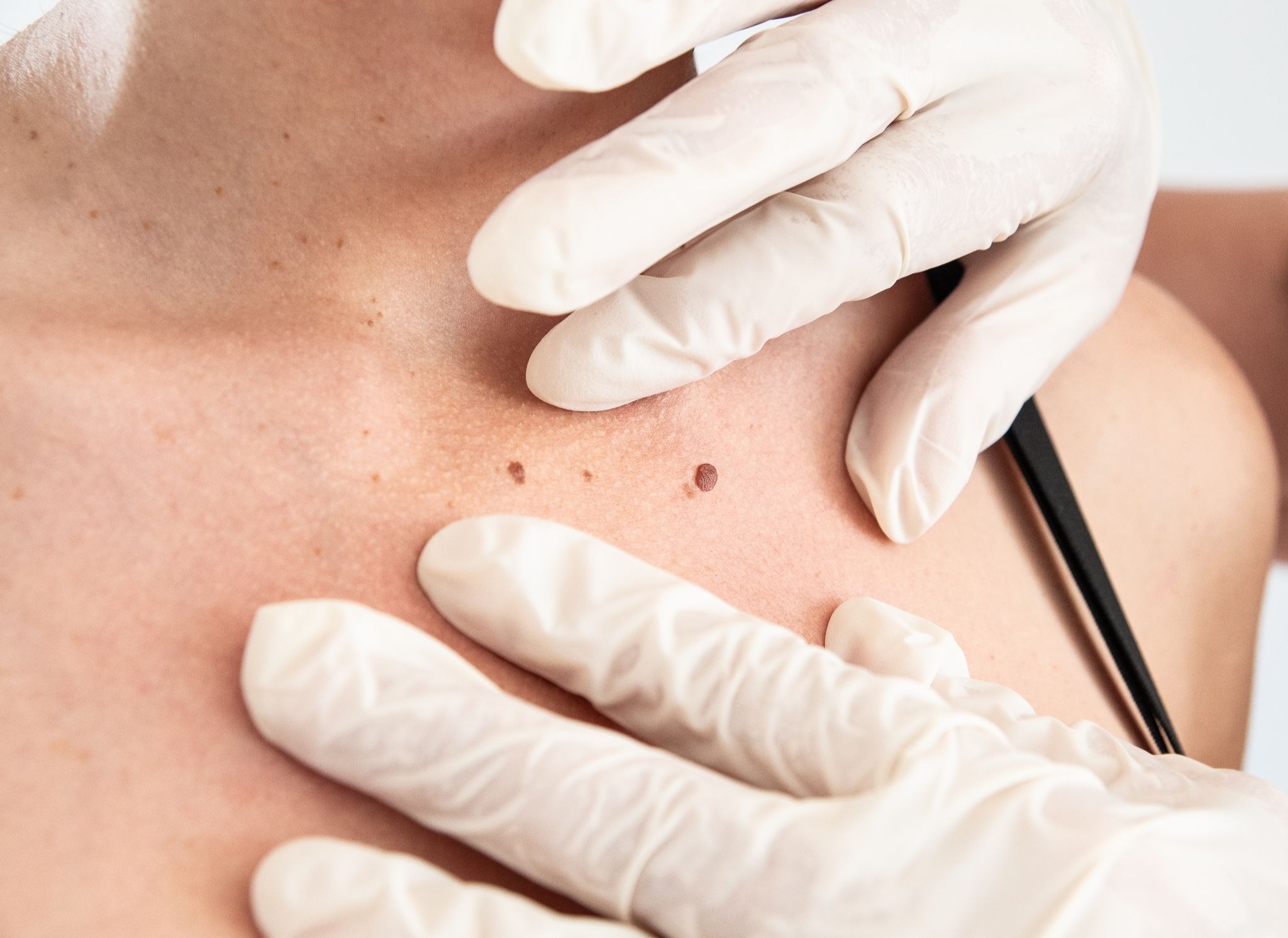 neoformazioni - Pietro Serra Chirurgo Plastico