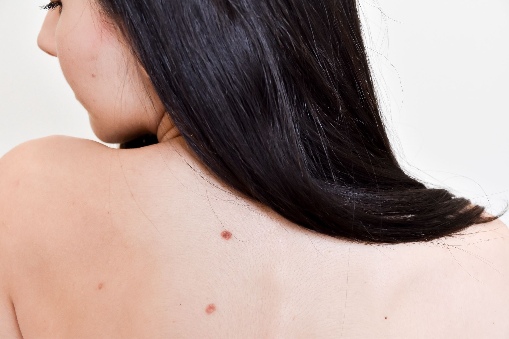 neoformazioni - Pietro Serra Chirurgo Plastico