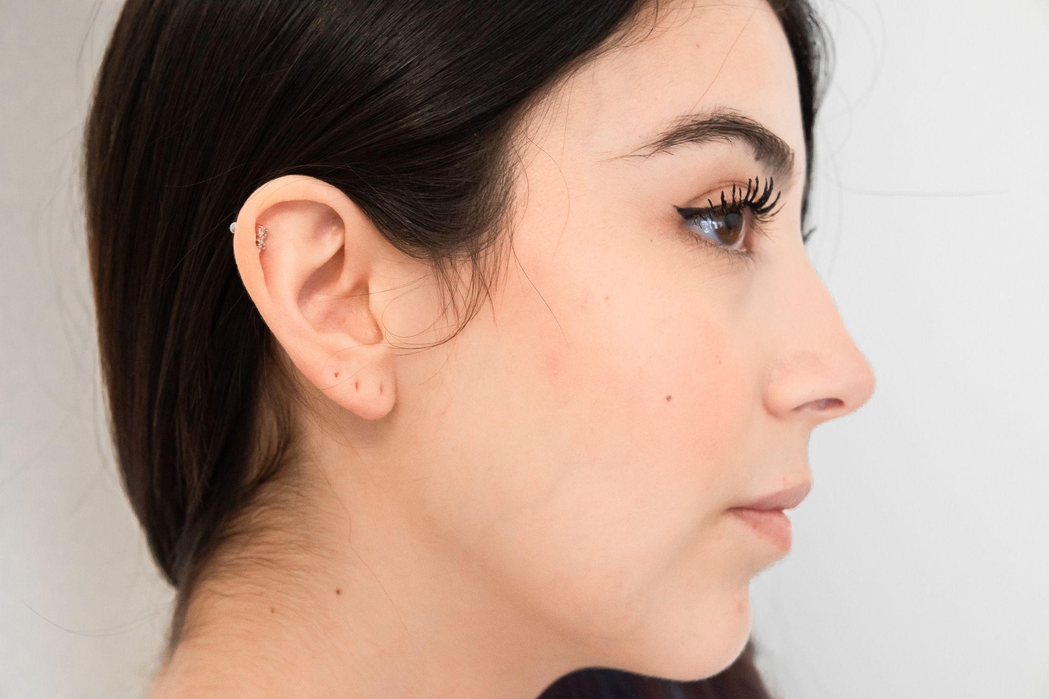 otoplastica - Pietro Serra Chirurgo Plastico